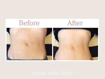 トータルビューティー ゆみえエステ(Total Beauty)/痩身/マグシェイプ ウエスト