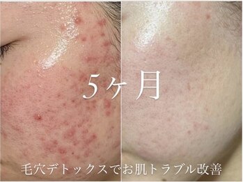 ファニービー 高槻店/ニキビケア10回