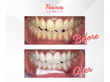 ティアナ 神栖店(Tiana)/ホワイトニング before/after