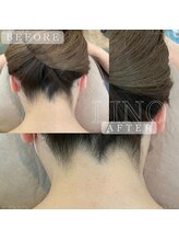 リノ(Lino)/憧れの全身脱毛もおてごろ