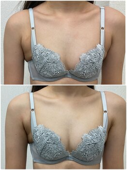 バーディー(BIRDIE)/施術1回/20代