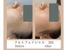 【光フェイシャルエステ】お肌の悩み全て解決♪破格の5500円♪