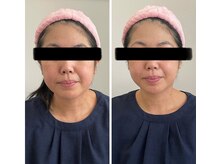 ブライトプラス(BRIGHT+)/毛穴洗浄+小顔ケア+小顔整体