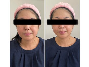 ブライトプラス(BRIGHT+)/毛穴洗浄+小顔ケア+小顔整体