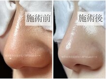 エール(aile)/毛穴ケアで黒ずみスッキリ