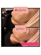 ティアメディカル(Tia Medical)/HIRFWAVEPro