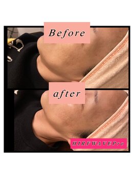 ティアメディカル(Tia Medical)/HIRFWAVEPro