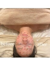 ミルズ 天神店(MillS)/リフトUPフェイシャル