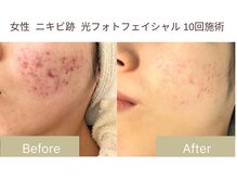 リフサロ(Rifsaro)の雰囲気（【光フォト】月一施術で肌質改善！）