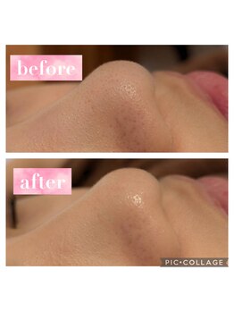 エステテックサロンラレーヌ 小山店(La Reine)/ポツポツ毛穴が気になる方に