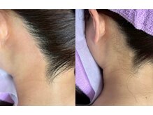 ティンク(Tink)/うなじワックス☆Before→After