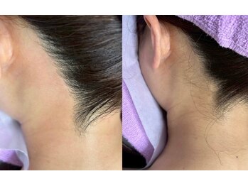 ティンク(Tink)/うなじワックス☆Before→After