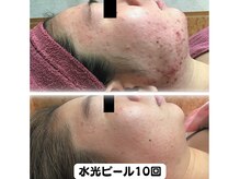 ラディアント たまプラーザ/水光ピール