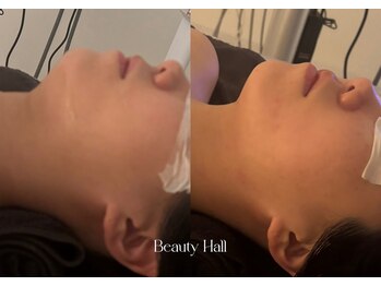 ピュアルクラ PURE LUCRA/脂肪分解の小顔レッドショット