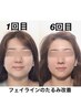《初回体験》フェイスラインがぼやけてきた方へ / たるみ改善