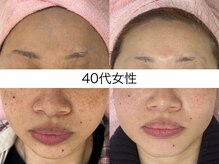 シミケア専門店 SAKURA 平塚店/42歳 6回の写真【フェイシャル】