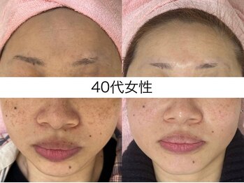 シミケア専門店 SAKURA 平塚店/42歳 6回の写真【フェイシャル】