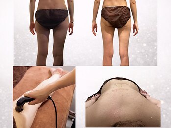 ビーエムビー(BMB)の写真/確かな結果と技術でサポート！本気のお尻痩せ＆太ももケアで理想のボディへ♪