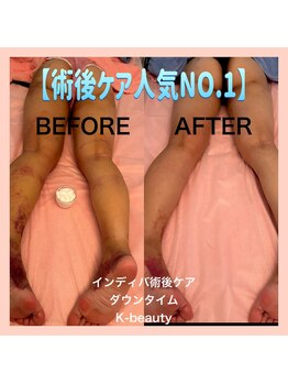 ケイビューティ(k-beauty)の写真/【徹底痩身で脱下半身太り】結果出しに自信◎むくみ/脂肪/筋肉の張りを解消！憧れのスラッと美脚に♪
