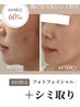 【美白/シミケア】人気NO1★500円玉2個分のシミケア+光フェイシャル♪¥10780