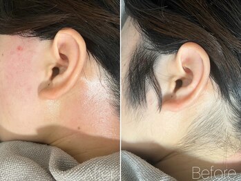 エヴァワックス 恵比寿店(Eva Wax)/【もみあげ脱毛】ビフォ-アフタ-