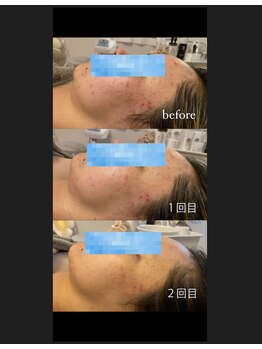 ミイン(miin)/ハーブトリートメント