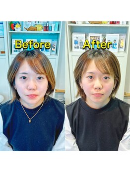 代々木美容鍼灸サロン さくら/美容鍼　before　after