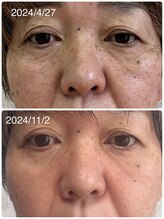 ココ(KOKO)/継続は力です。4回での変化　