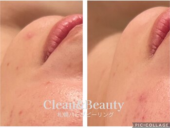 クリーンアンドビューティ 札幌(Clean&Beauty)/施術もスキンケアもご相談に◎