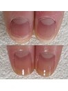 むしり癖からツルツル美爪に