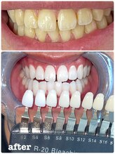 エクシアホワイトニング 札幌中島公園店/Before After［ホワイトニング］