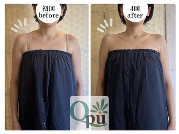 キュープ 福岡天神店(Qpu)/巻き肩コース1回での変化