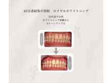 プラスビーセルフ(+b self)/ホワイトニングビフォーアフター