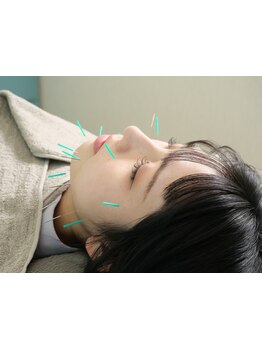 鍼灸施術を受けたい