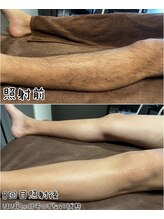 メンズサロン エイチ(H)/両脚脱毛8回照射