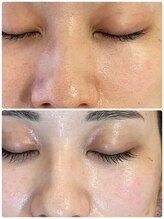 ロッシュ フェイス(Roche Face)/20代女性