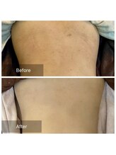 ビビ(VIVI)/背中ニキビケアハーブピーリング