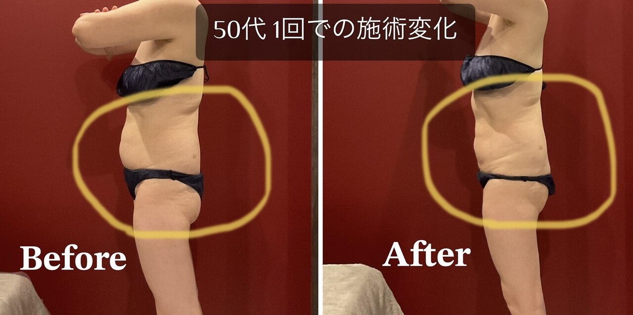 二の腕・ハミ肉ケアをしたい！前橋・高崎・伊勢崎・太田・群馬で