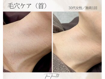 スリースリー(THREE THREE)/毛穴ケア(首)