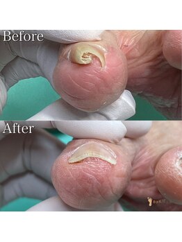 巻き爪補正店 札幌店/【巻き爪補正】