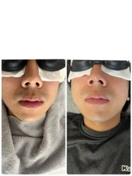 フォーグッド(forgood)/ヒゲ脱毛