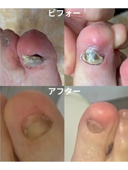 フットケア蘇 辛島店(SO)/爪のお手入れ