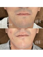 アトラ(Attra)/メンズヒゲ脱毛