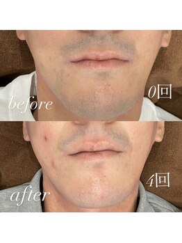 アトラ(Attra)/メンズヒゲ脱毛