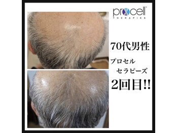 ヒルナム(Heal Nam)/プロセルセラピーズ　~頭皮~