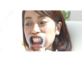 ロス(LOSS)/1-マウスオープナー装着