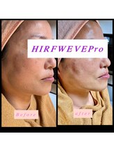 ティアメディカル(Tia Medical)/HIRFWAVEPro