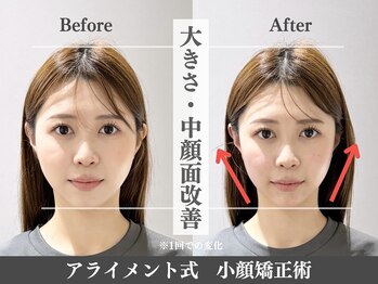 アライメント 自由が丘(Alignment)/大きさ・中顔面改善