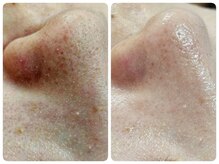 リセラージュ(Recellage)/TENNYO★肌育毛穴洗浄