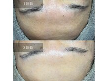 ダブル(W)/ハーブピーリング×毛穴ケア